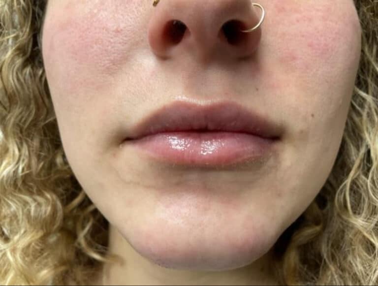 After Image: Lip Filler - front