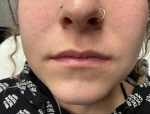 Before Image: Lip Filler