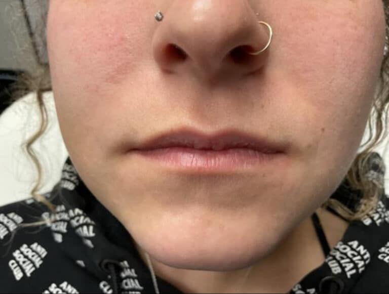 Before Image: Lip Filler - front