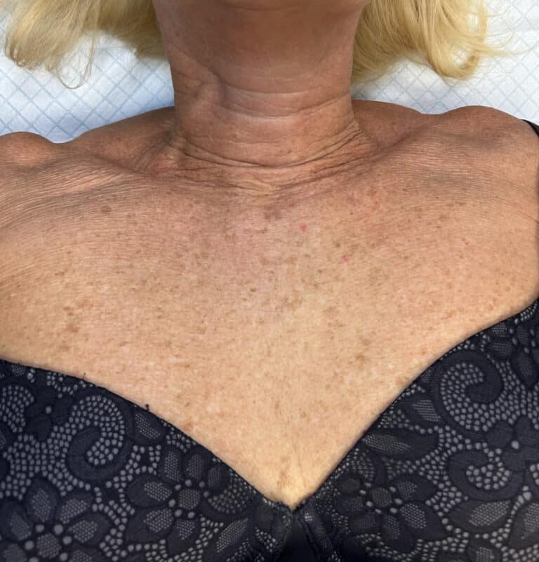 Before Image: IPL - front