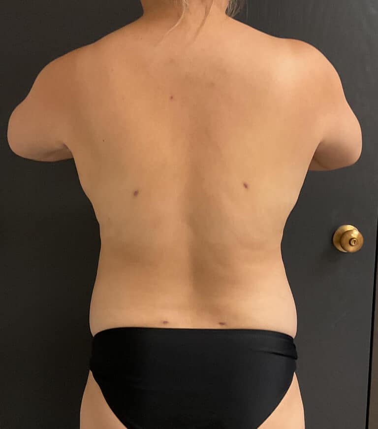 After Image: Liposuction - back