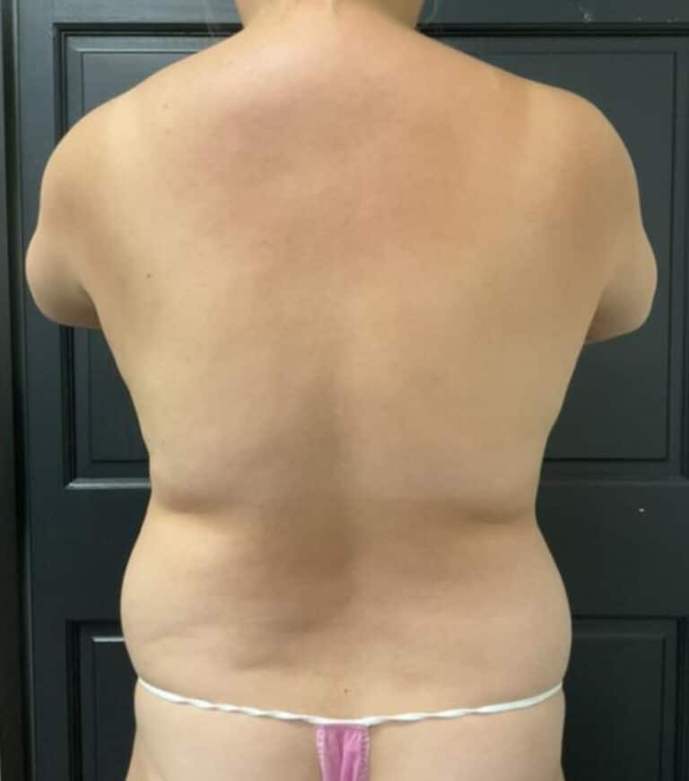 Before Image: Liposuction - back