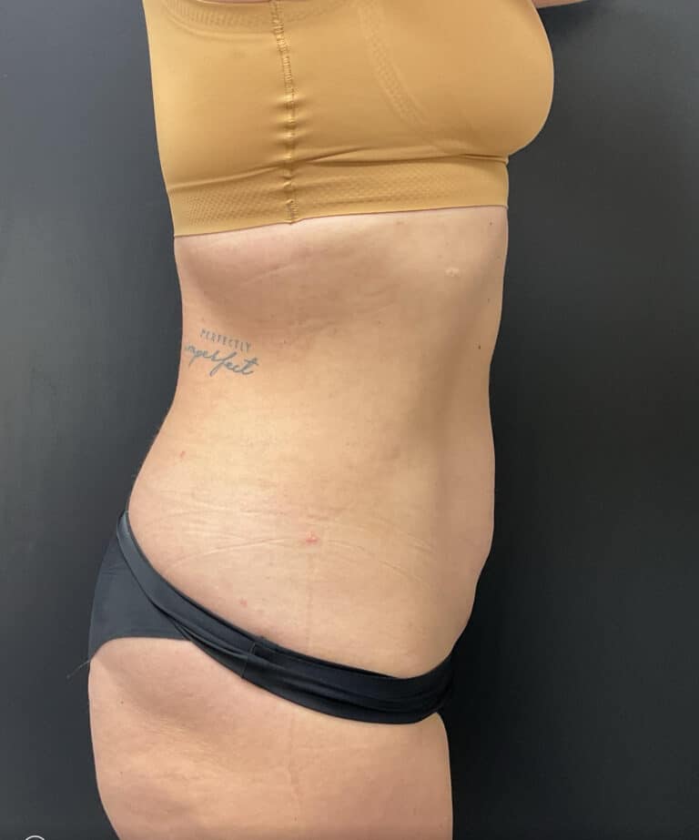 After Image: Liposuction - right-side