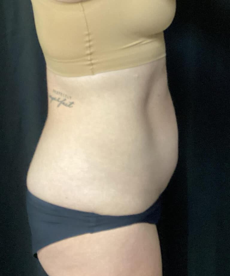 Before Image: Liposuction - right-side