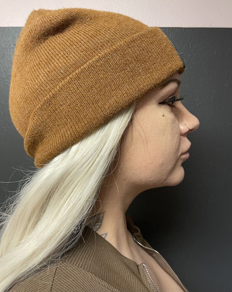 After Image: FaceTite - right-side
