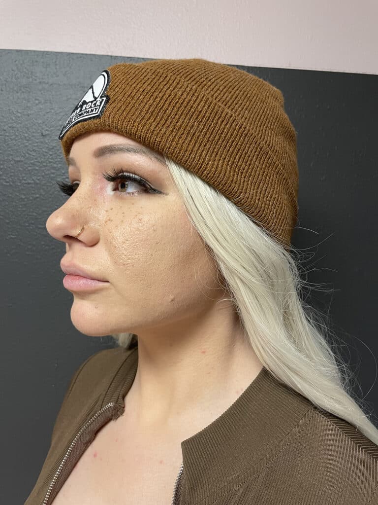 After Image: FaceTite - left-front-oblique