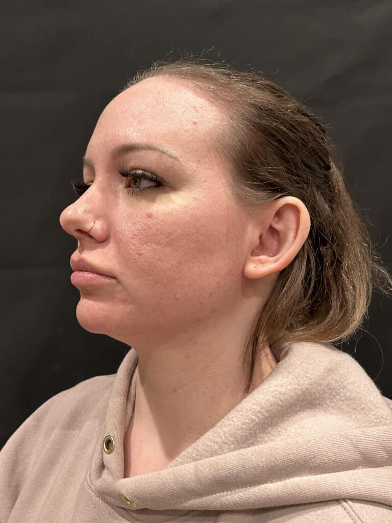Before Image: FaceTite - left-front-oblique