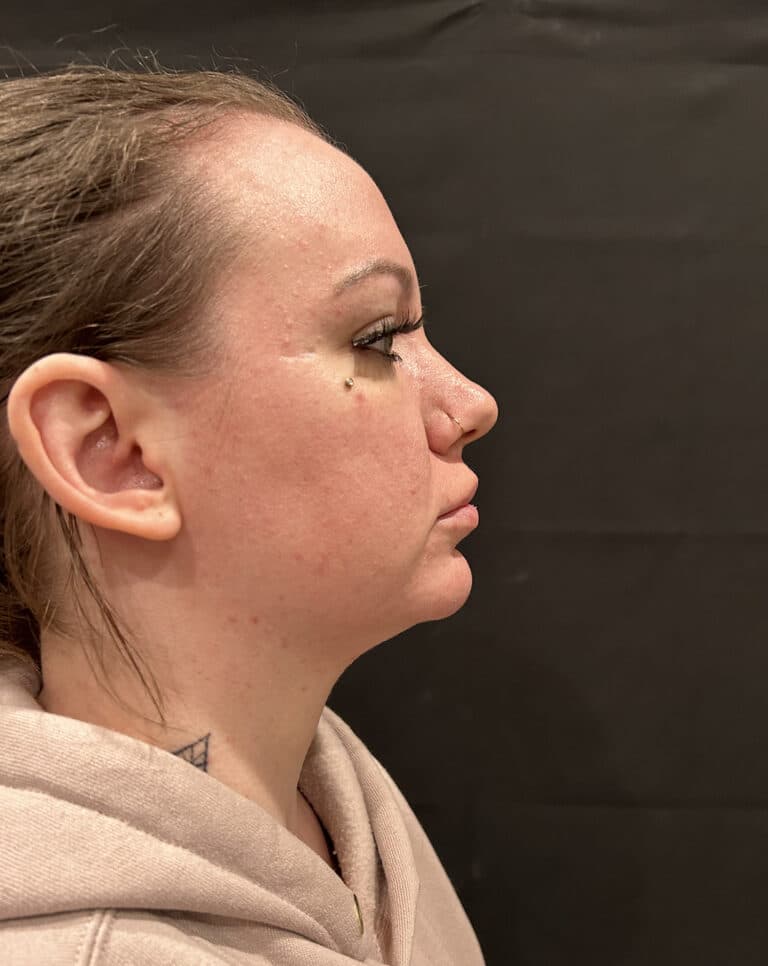 Before Image: FaceTite - right-side