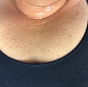 Before Image: IPL Neck
