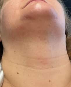 After Image: Laser Hair Removal Neck