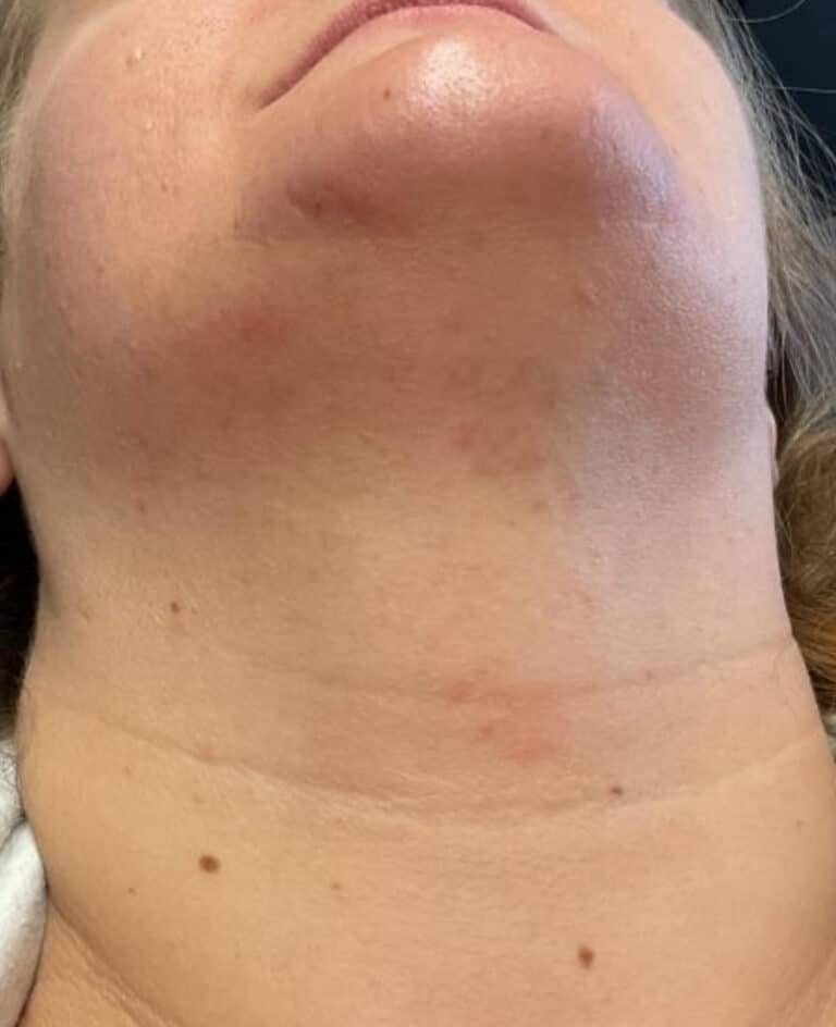 After Image: Laser Hair Removal Neck - front