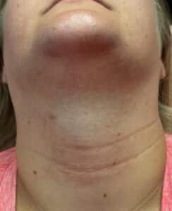 Before Image: Laser Hair Removal Neck