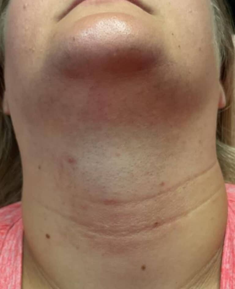 Before Image: Laser Hair Removal Neck - front