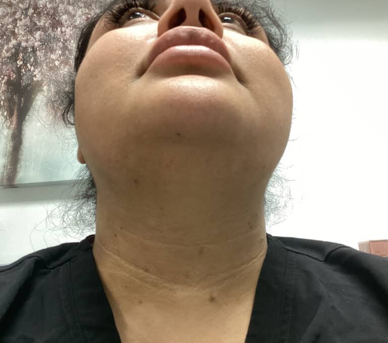 After Image: Laser Hair Removal - front