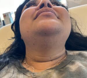 Before Image: Laser Hair Removal