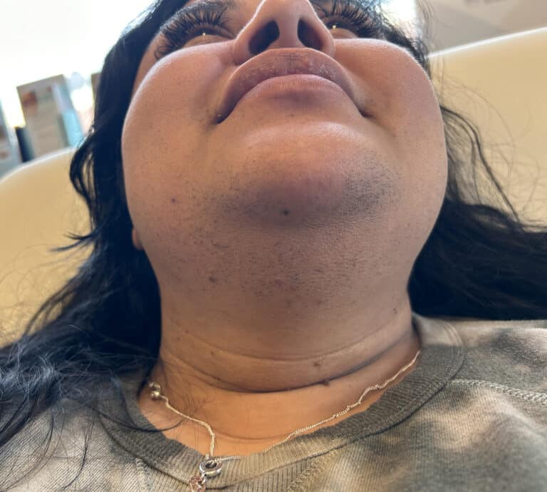 Before Image: Laser Hair Removal - front