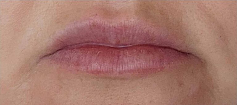 After Image: Lip Filler Appleton - front
