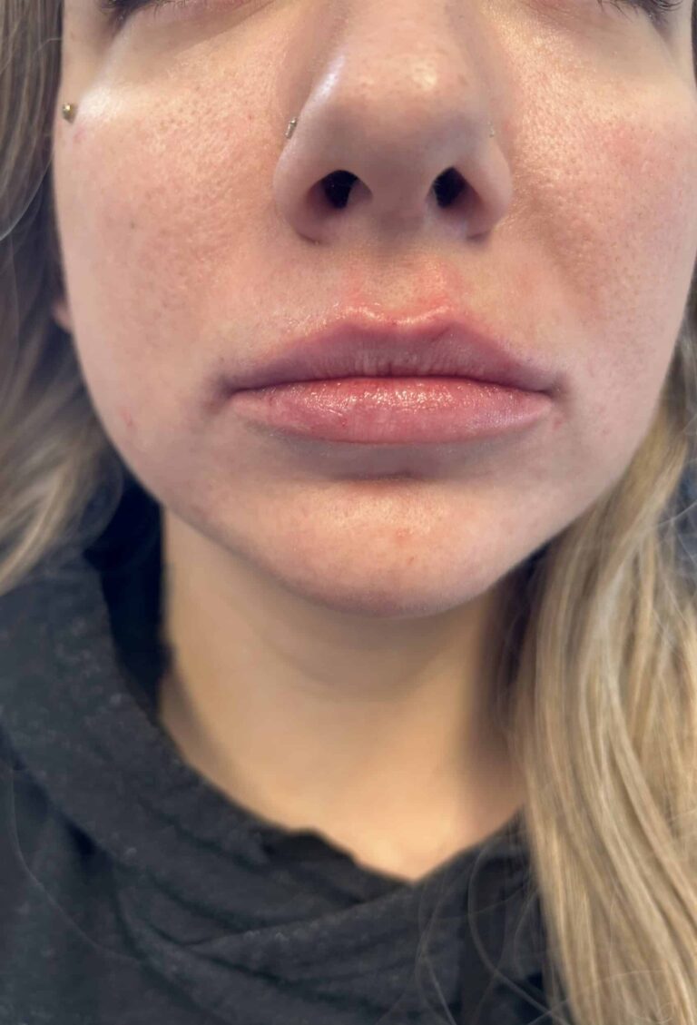 After Image: Lip Filler Appleton - front