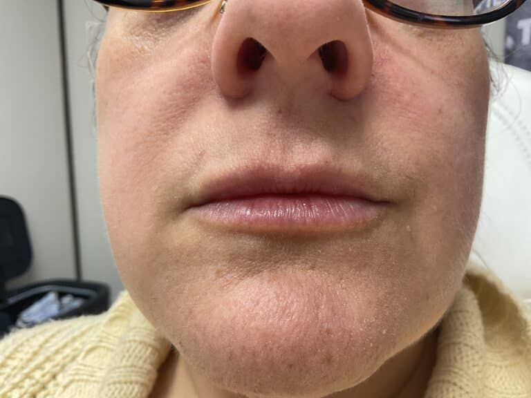 After Image: Lip Filler Appleton - front