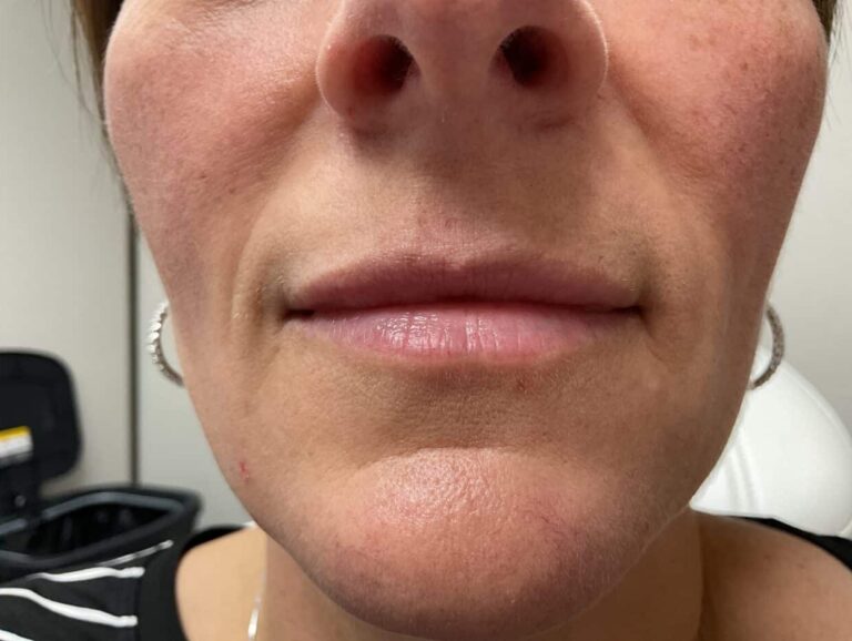 After Image: Lip Filler Appleton - front