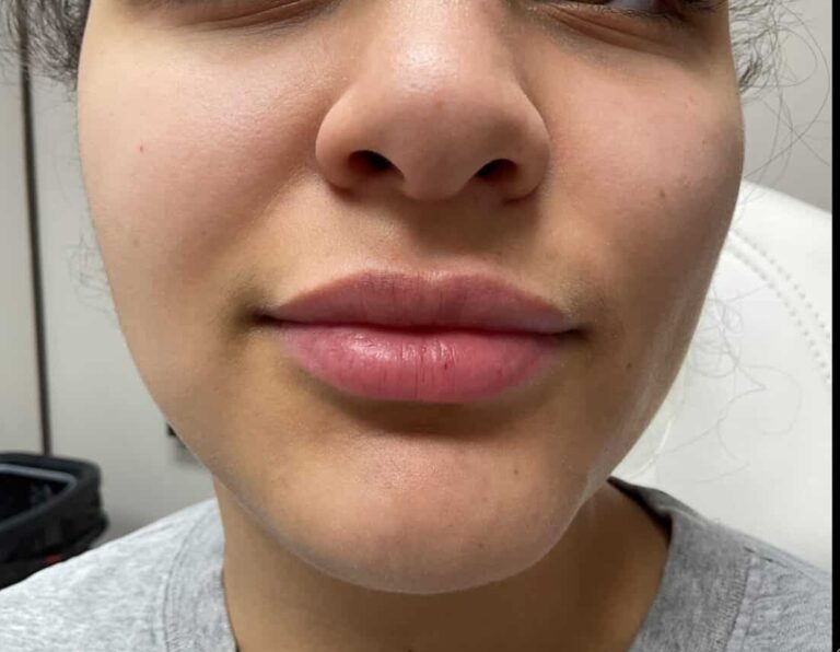 After Image: Lip Filler - front