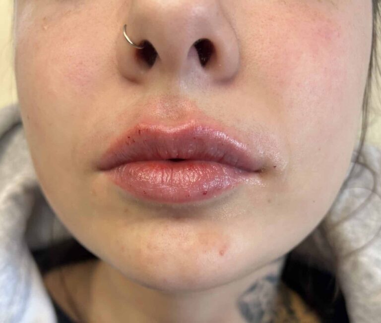 After Image: Lip Filler Appleton - front