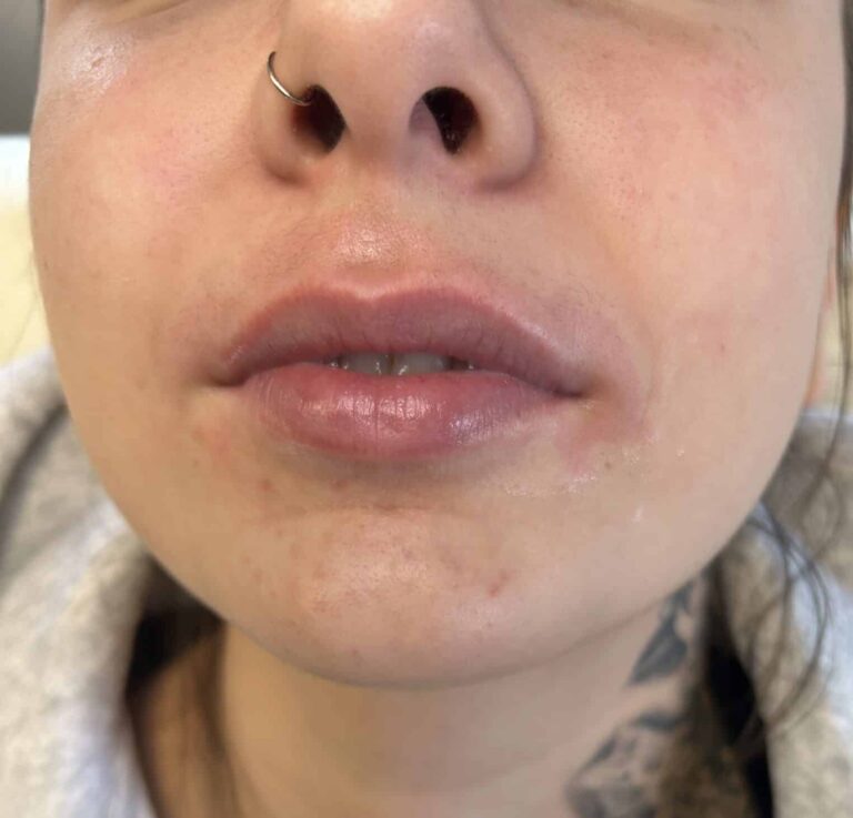 Before Image: Lip Filler Appleton - front