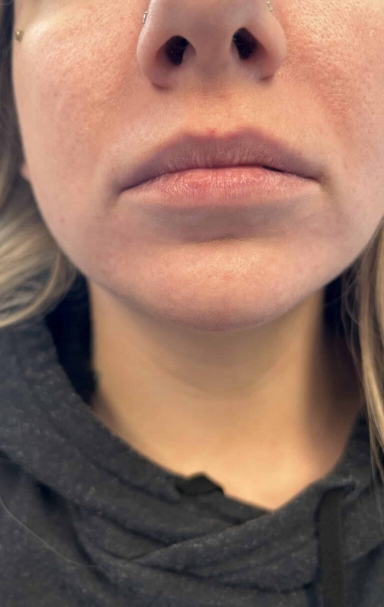 Before Image: Lip Filler Appleton - front